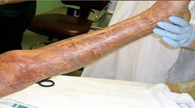 Kutu denizanasının saldırısından kurtulan 10 yaşındaki Rachael Shardlow'un saldırı sonrası bacağında yarattığı etki